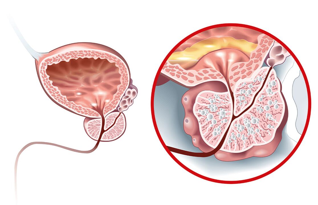 Adenom ve prostatit ile prostata ne olur 