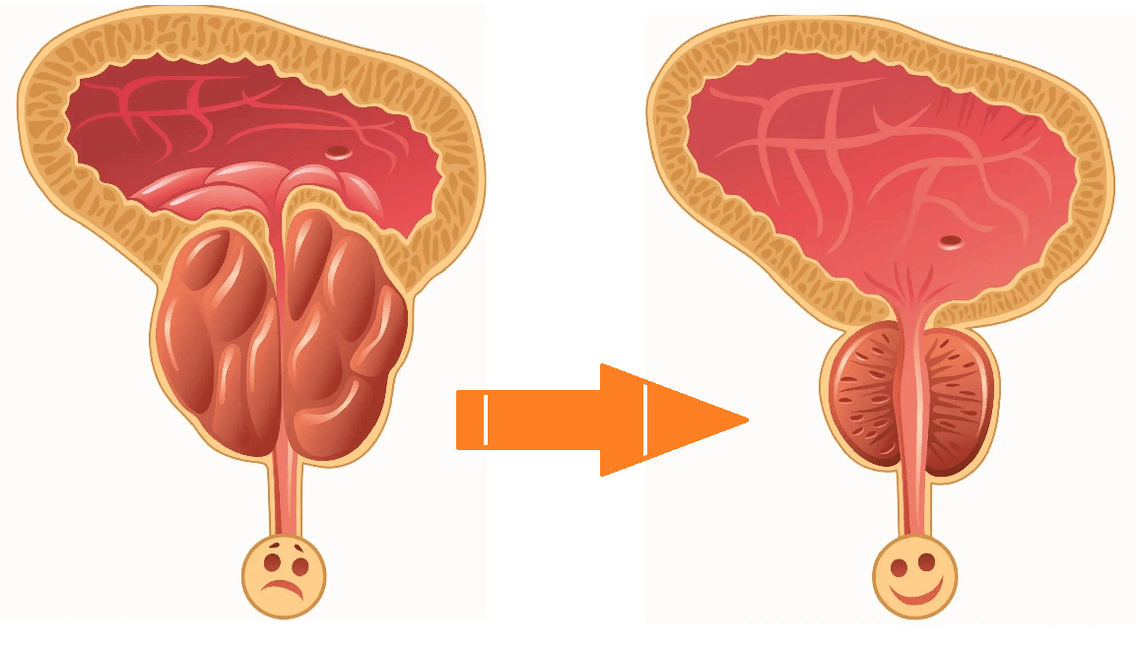 Uromexil Forte'in prostatit ve adenomlu prostat üzerine etkisi